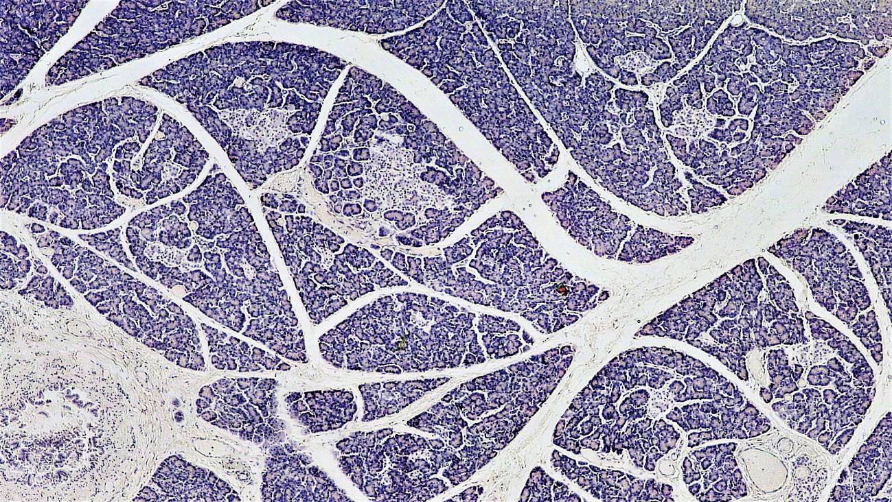 Más cerca del objetivo de tratar la diabetes tipo 1 con trasplantes de islotes pancreáticos