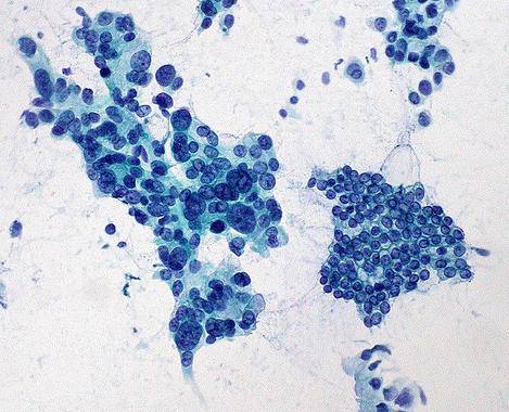 Mejora nuestra comprensión del desarrollo del cáncer de páncreas