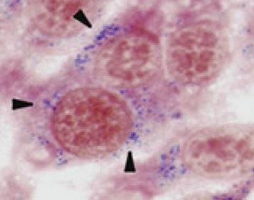 Nanopartículas en el interior de las células tumorales.