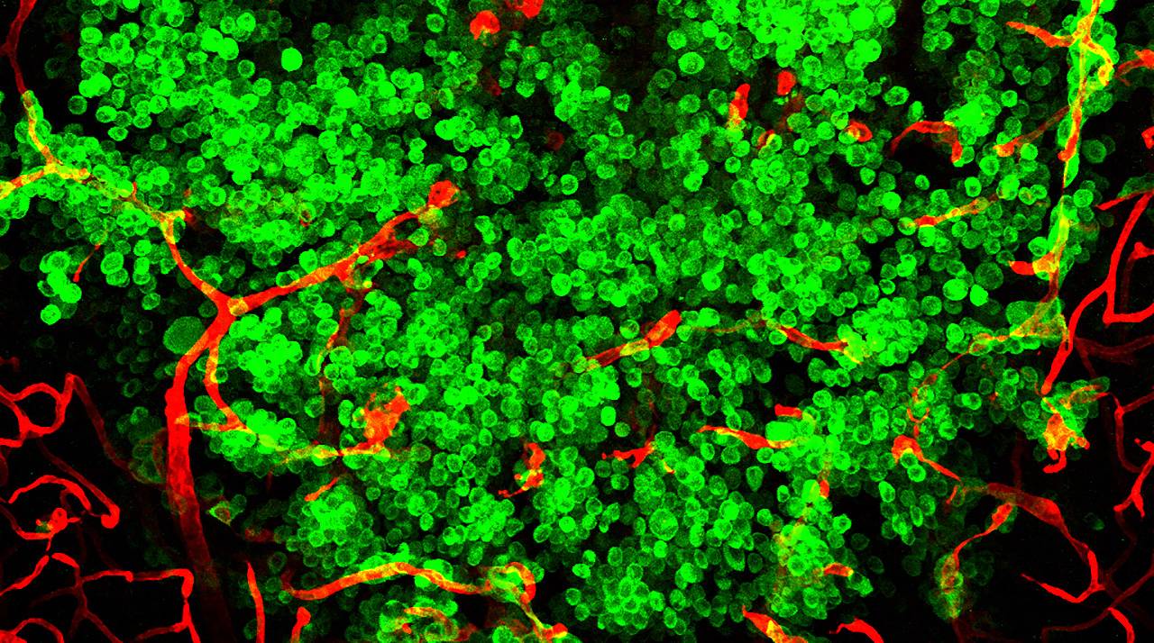 Nueva plataforma colaborativa para agilizar la investigación en metástasis cerebral