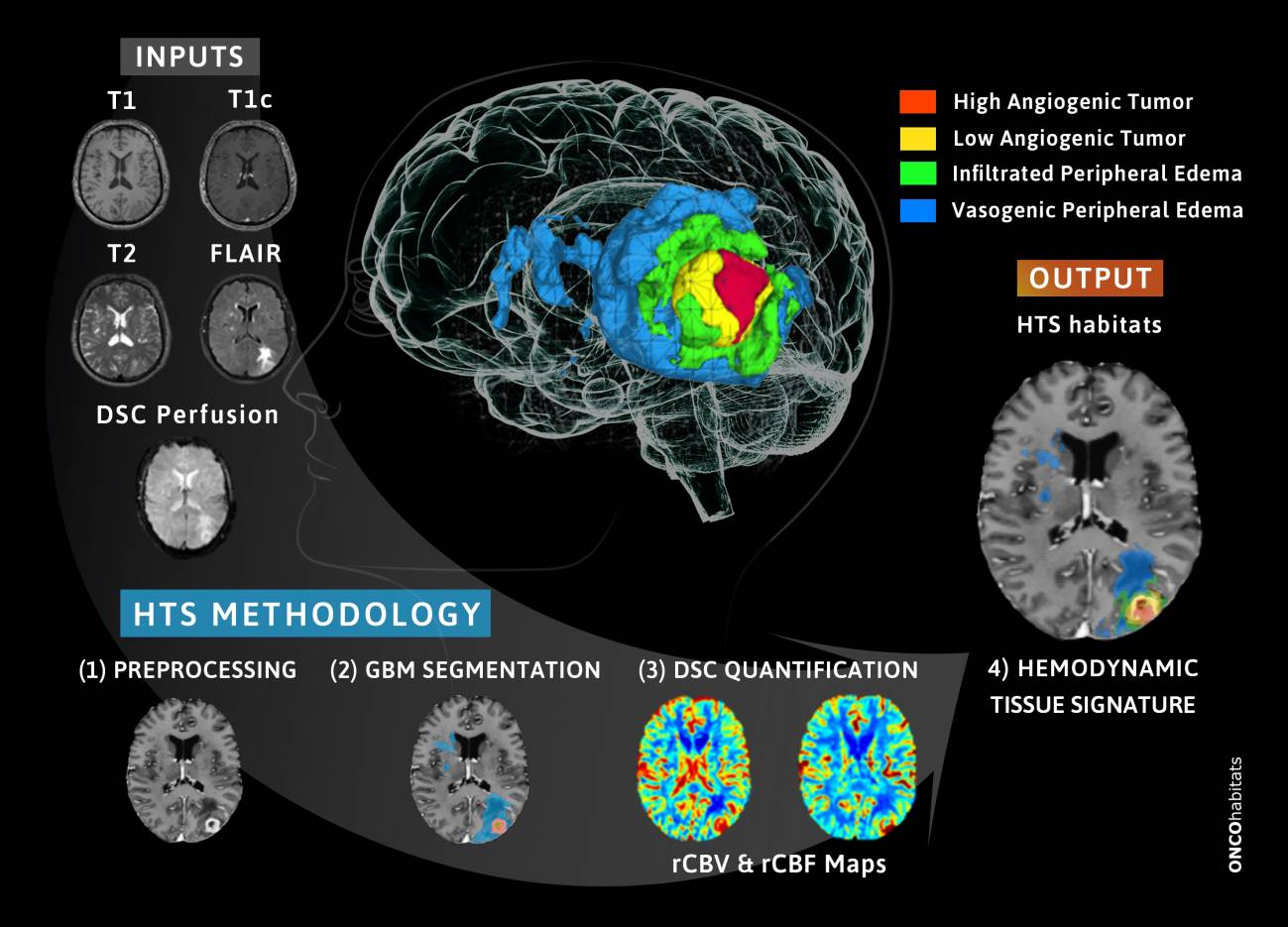 Nueva plataforma para ayudar al pronóstico y seguimiento de pacientes con glioblastoma