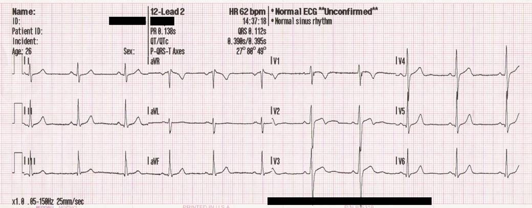 Electrocardiograma. / Wikipedia