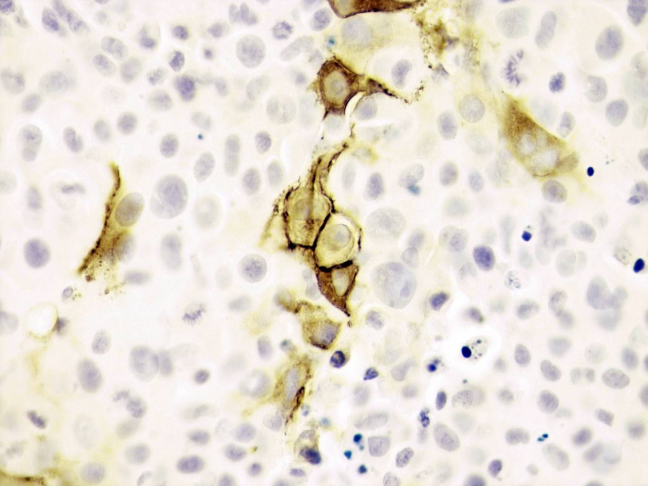 Nueva terapia génica para tratar diferentes tipos de cáncer con yodo radiactivo