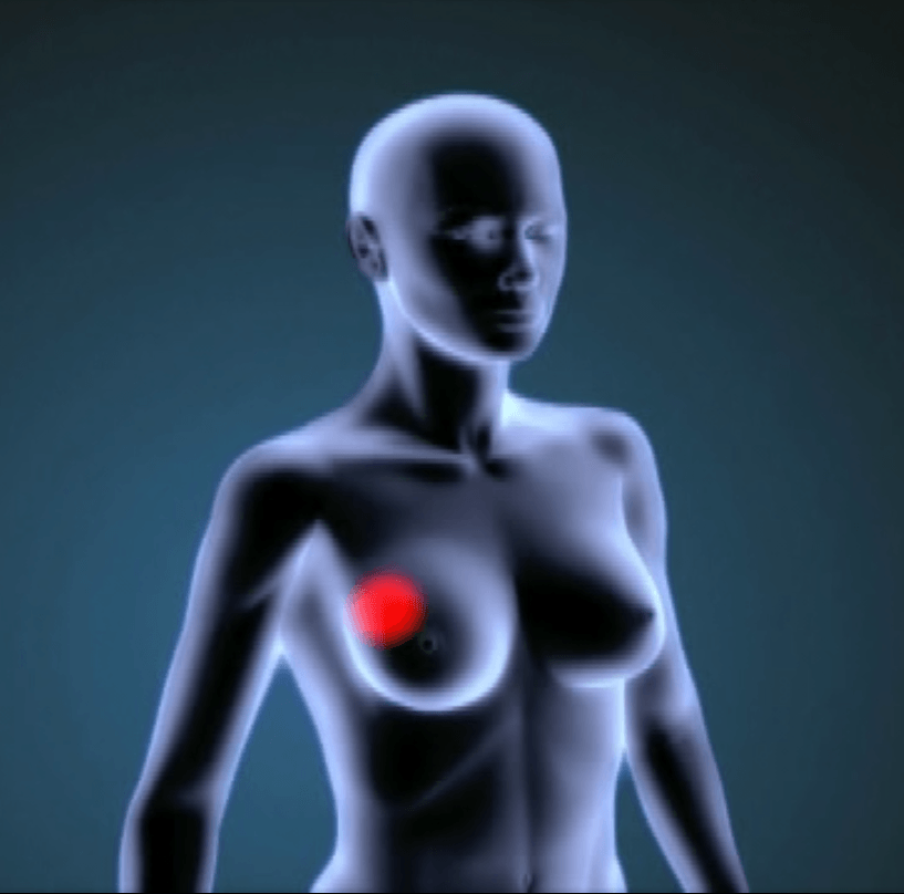 Nuevas combinaciones de fármacos contra el cáncer de mama gracias a la bioinformática