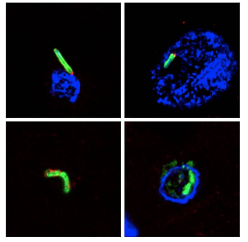 Nuevas infecciones microbianas en cerebros de personas fallecidas por alzhéimer 
