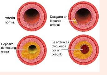 Nuevo mecanismo para revertir la aterosclerosis