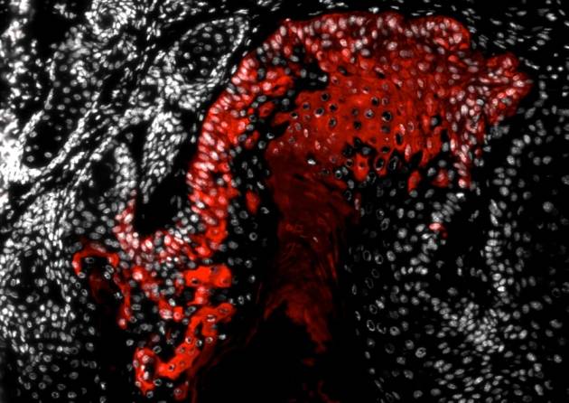 Nuevos estudios indican que las células madre activan el crecimiento de los tumores