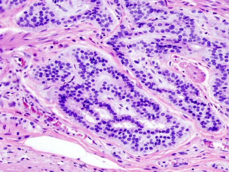 carcinoma de colon
