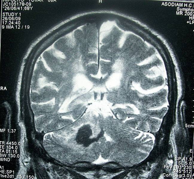 accidente cerebrovascular