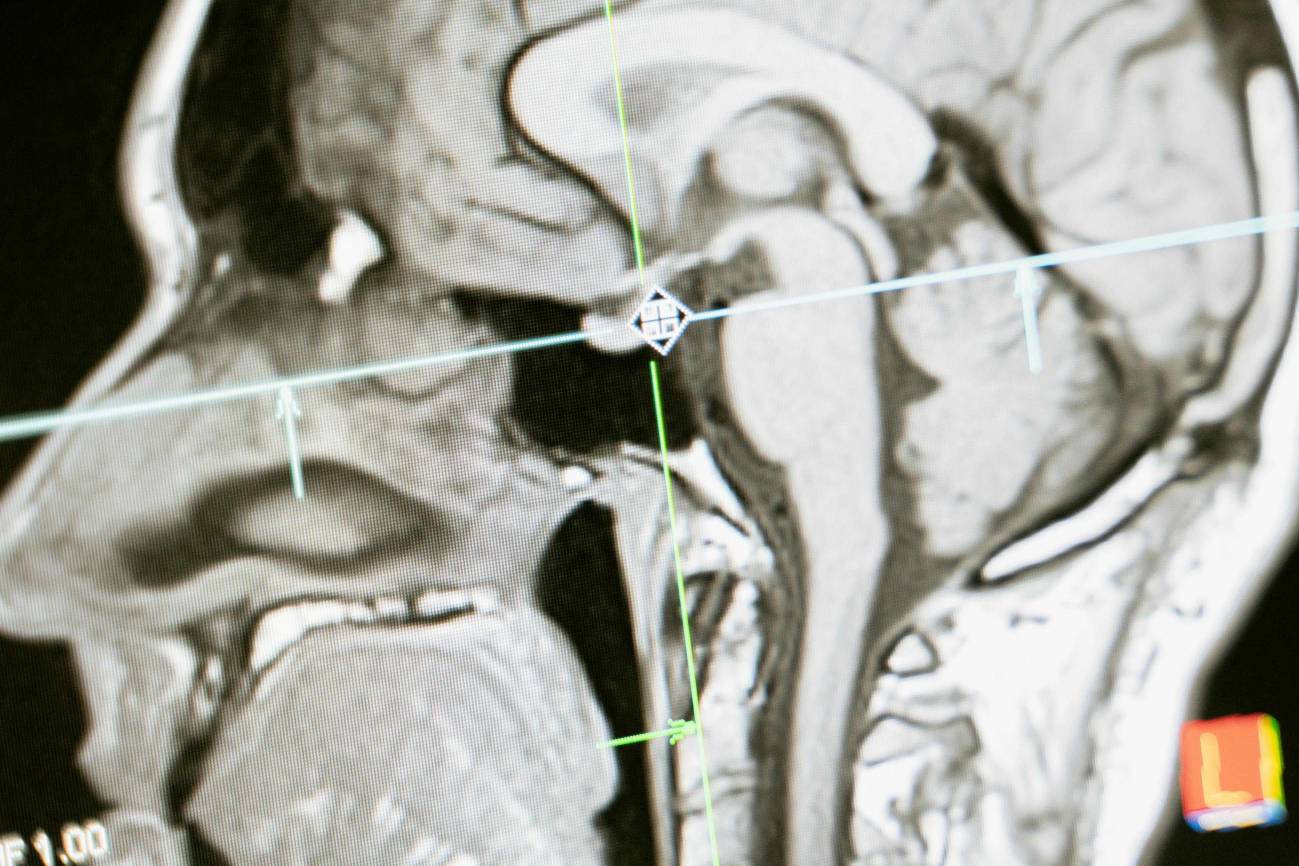 Reducen un 90 % el tiempo para obtener resonancias magnéticas con inteligencia artificial