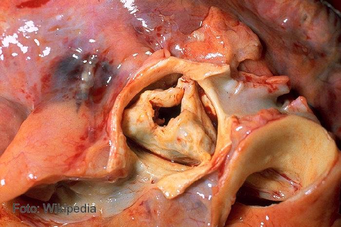Relacionan el riesgo cardiovascular con las patologías que afectan a la vena aorta