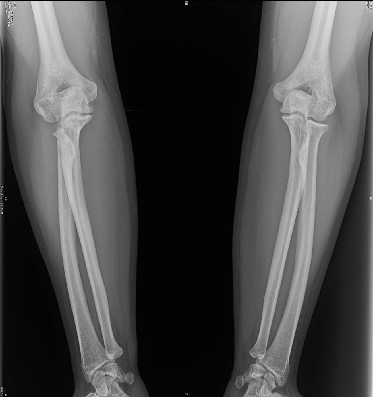 Resección: un tratamiento satisfactorio para algunas fracturas del codo