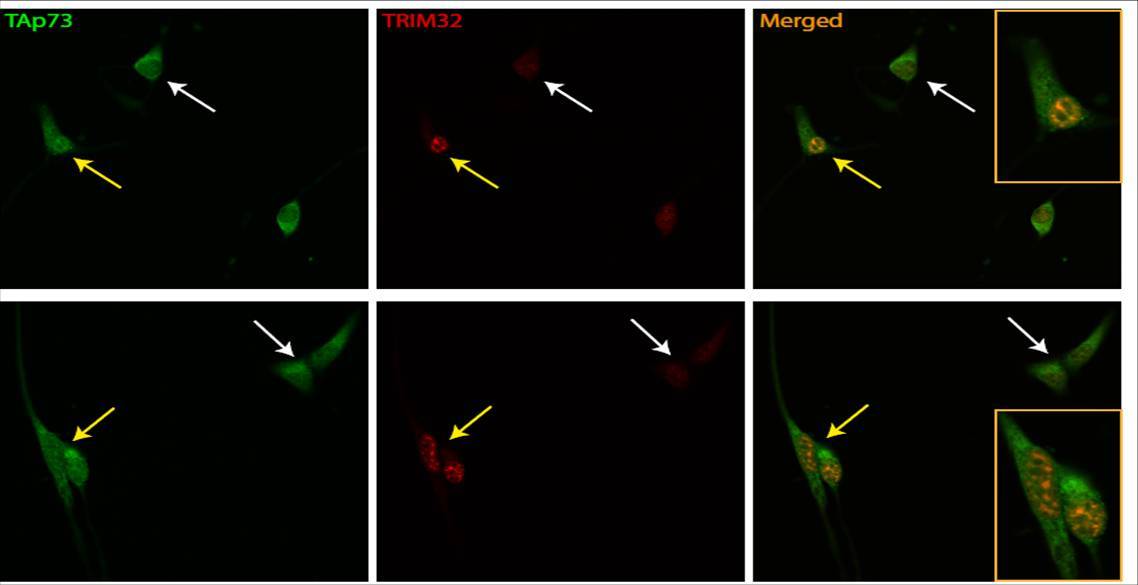 TP73 y TRIM32 están implicados en enfermedades neurodegenerativas como alzhéimer y párkinson y en el cáncer