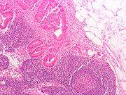 Se identifican mutaciones españolas en un gen asociado al cáncer colorrectal hereditario