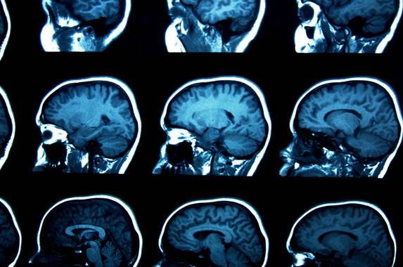 Terapia metabólica para mejorar la motricidad en síndrome Rett atípico