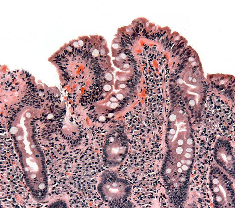 Biopsia de intestino delgado de un paciente con celiaquía.