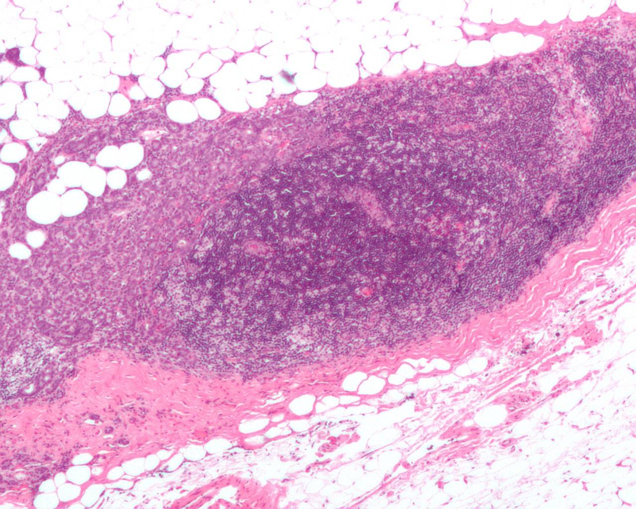 ganglio linfático invadido por un carcinoma ductal de mama