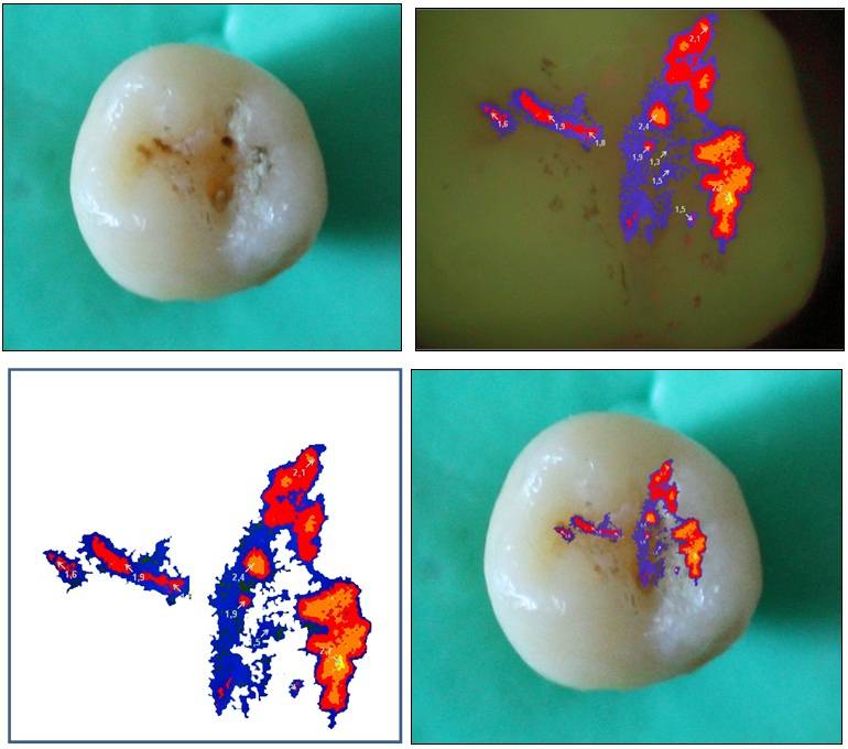 Los investigadores tratan de "revolucionar" las consultas al dentista con la detección temprana de las caries.