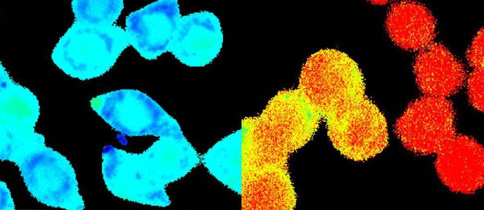 Un estudio descubre una alta entrada de calcio en las células de cáncer colorrectal