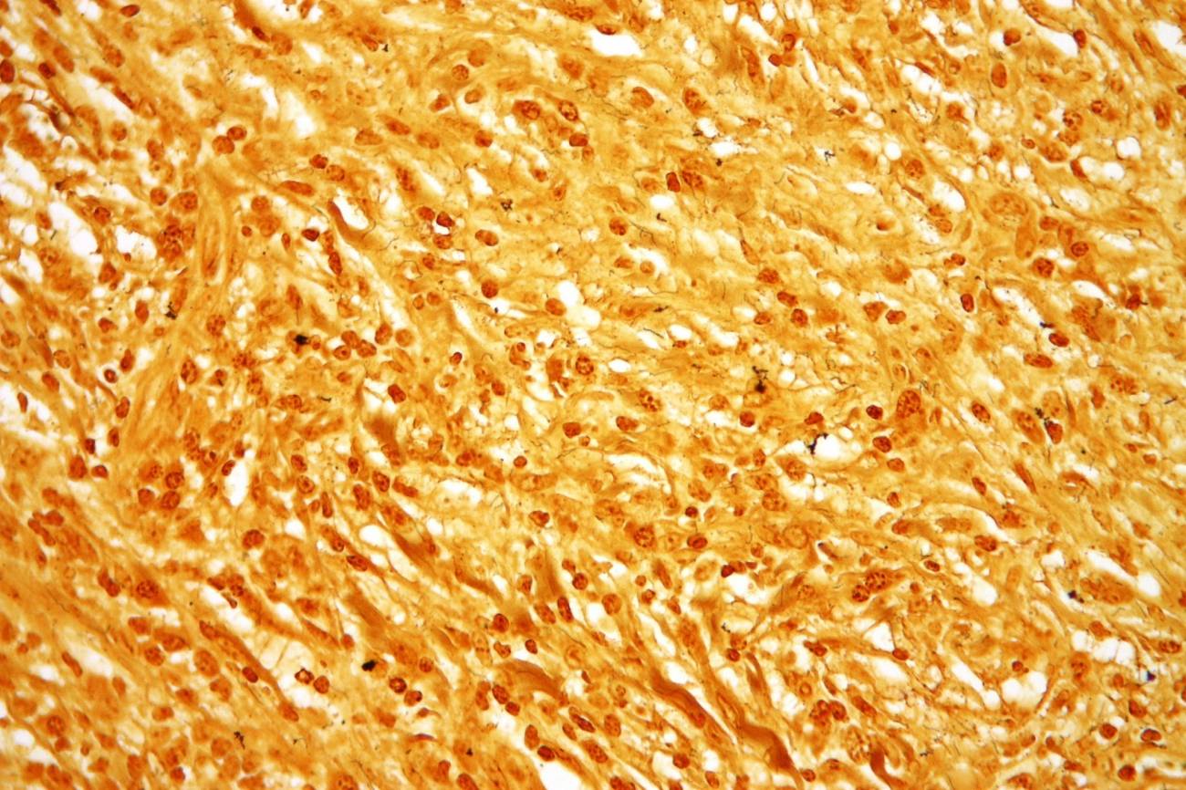 Un estudio genético fija el origen de la bacteria de la sífilis en el siglo XVIII