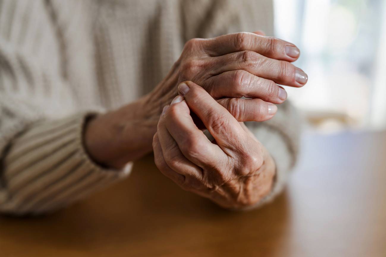 Manos de una persona con artritis reumatoide