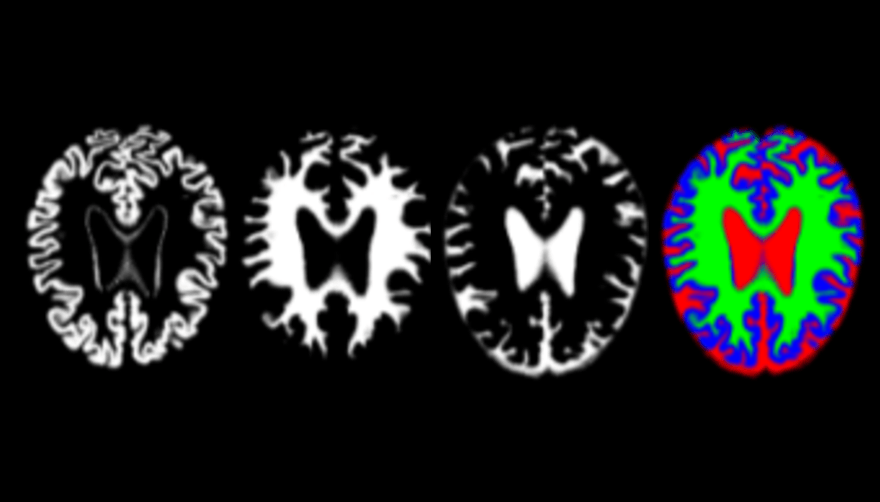 imágenes de resonancia de cerebros con alzhéimer