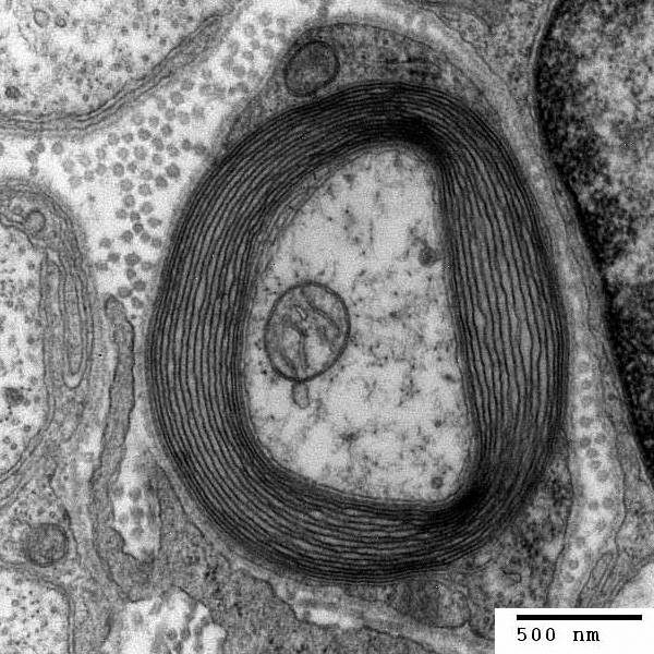 Un nuevo biomarcador mejora el diagnóstico de la esclerosis múltiple