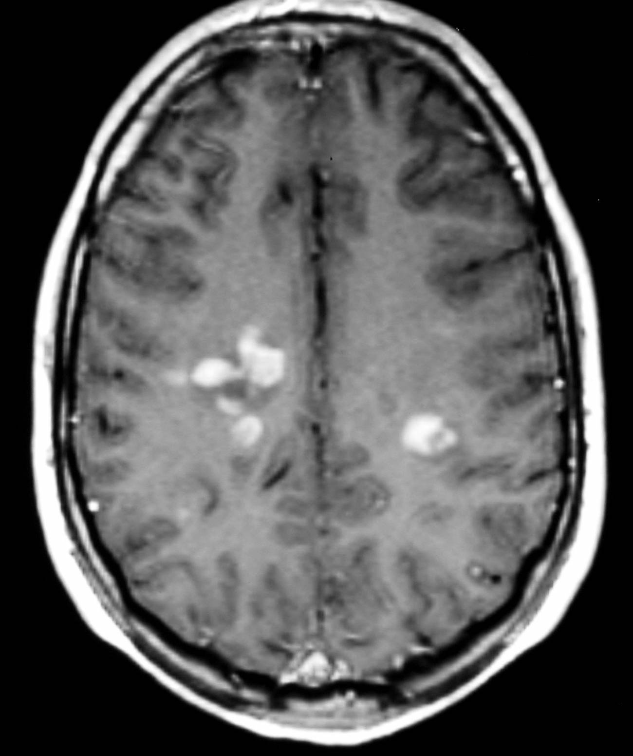 La esclerosis múltiple es una enfermedad crónica e inflamatoria del sistema nervioso central (cerebro y la médula espinal).