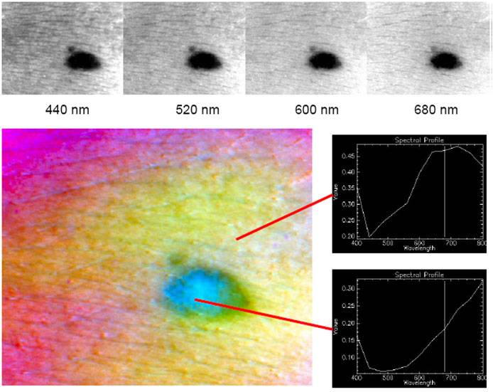 Imagen melanoma