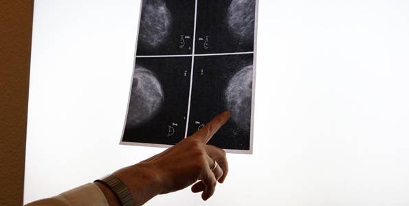 Un software estima la dosis de radiación tras la operaciones de tumores