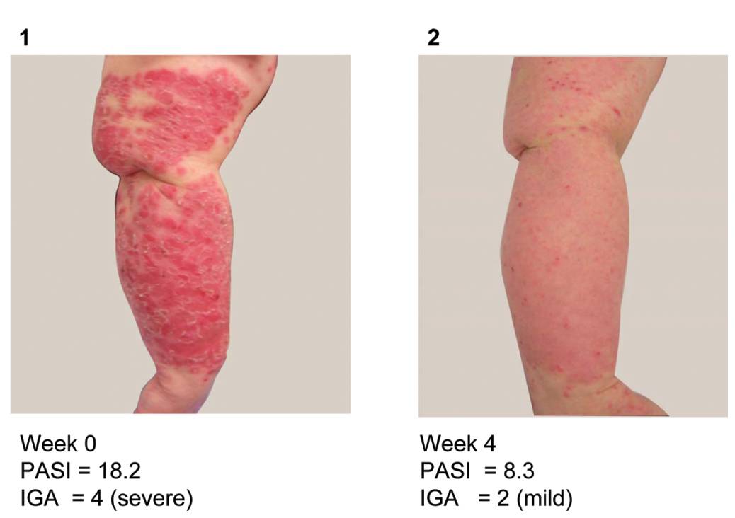 Un único anticuerpo combate la psoriasis, la inflamación de los ojos y la artritis