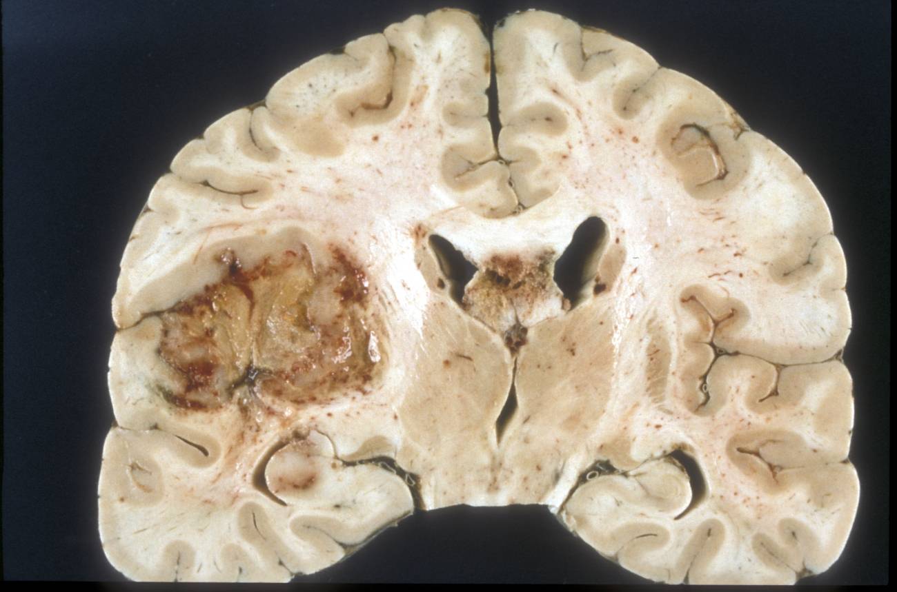 Una alteración bioquímica, responsable de la resistencia de tumores cerebrales agresivos