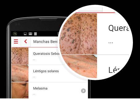 Una ‘app’ gratuita para mejorar el diagnóstico precoz del cáncer de piel
