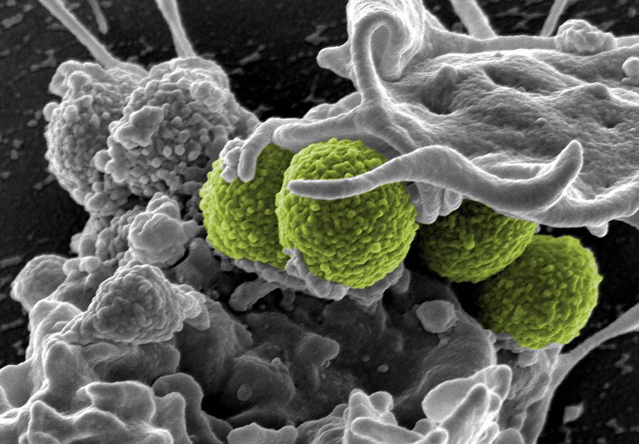 infección bacteriana por S. aureus