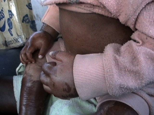 Una flora intestinal pobre contribuye a la desnutrición severa en niños
