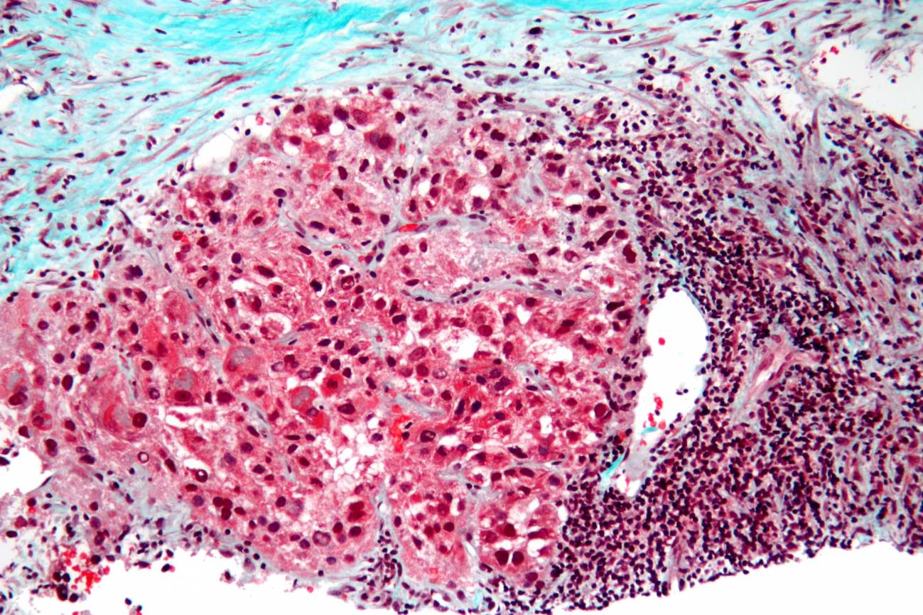 carcinoma hígado