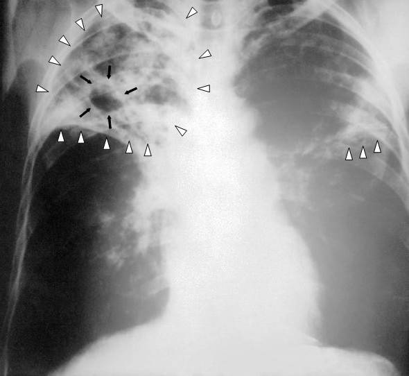 Una nueva familia de antibióticos contra la tuberculosis