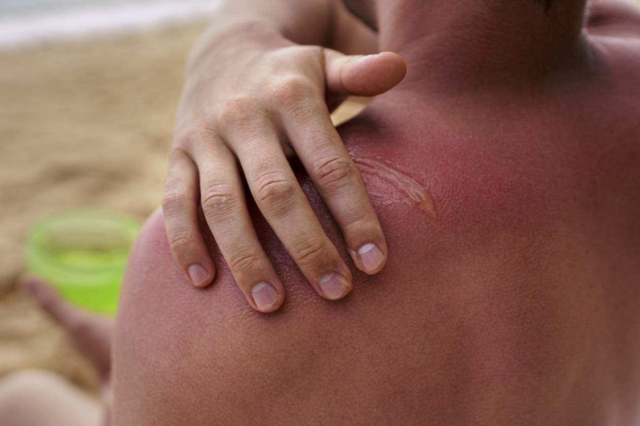 Una persona aplicando crema solar en piel quemada. 