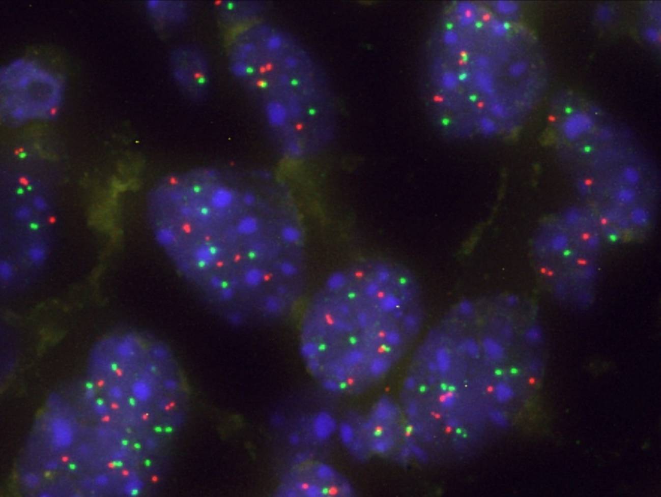 Imagen de un grupo de células tumorales pulmonares con aumento de KRAS para superar la barrera natural Capicua. / CIC