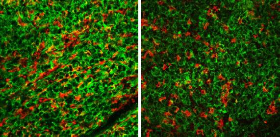 Una proteína de los tejidos conectivos favorece la metástasis tumoral