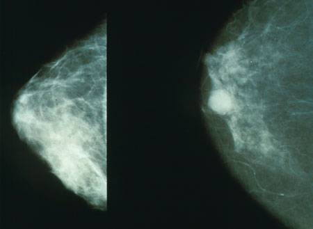 Una técnica reduce a cero las segundas intervenciones por cáncer de mama