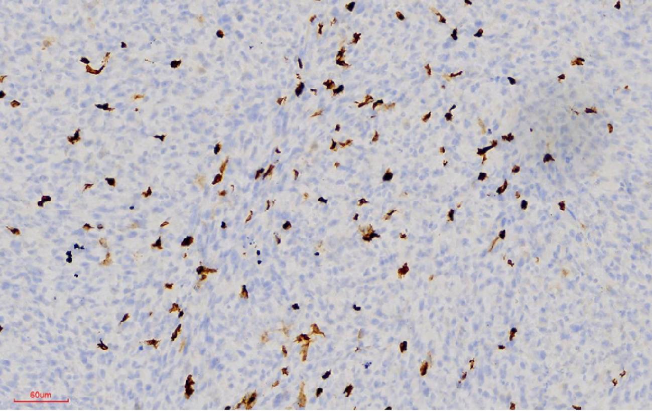 Infiltración de células del sistema inmunológico 