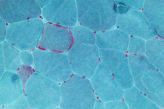 Unas ‘tijeras’ moleculares cortan las mutaciones que causan enfermedades hereditarias