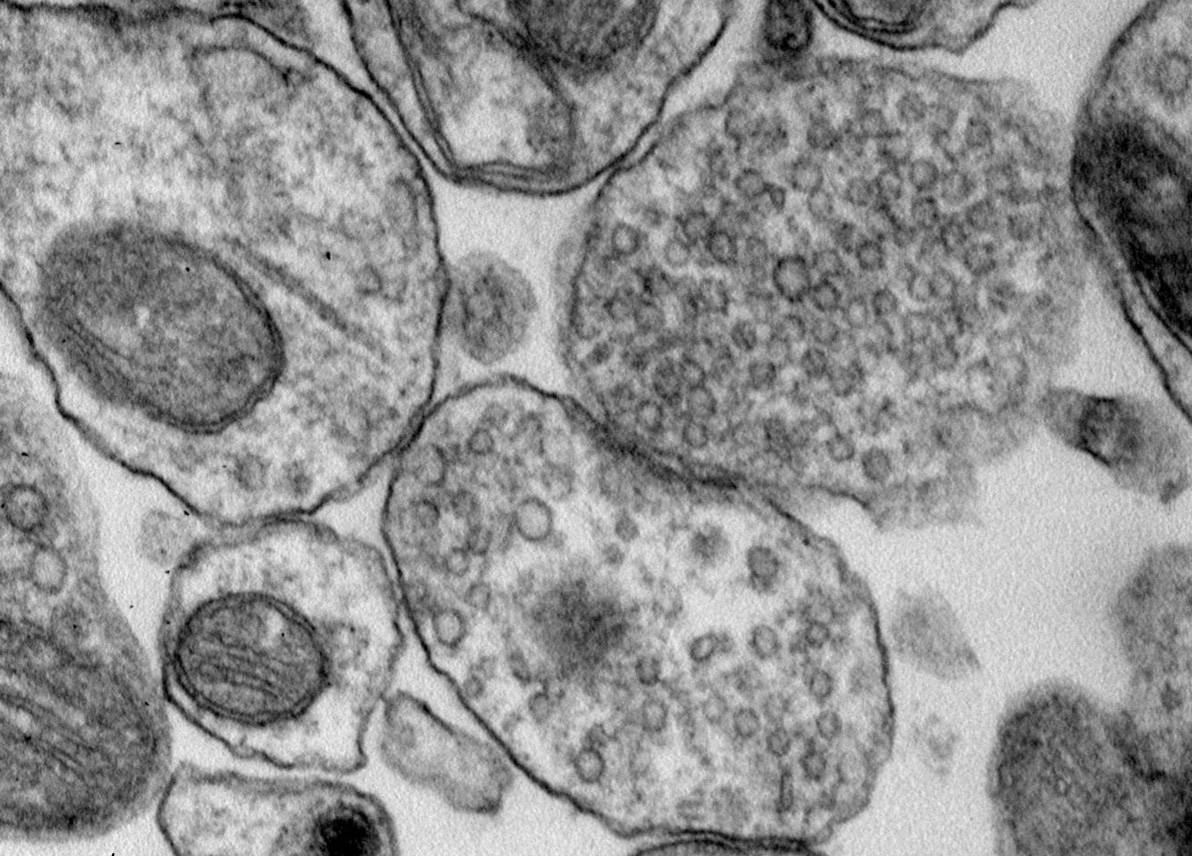 Vinculan la enfermedad de Niemann Pick tipo A  a un problema de comunicación neuronal