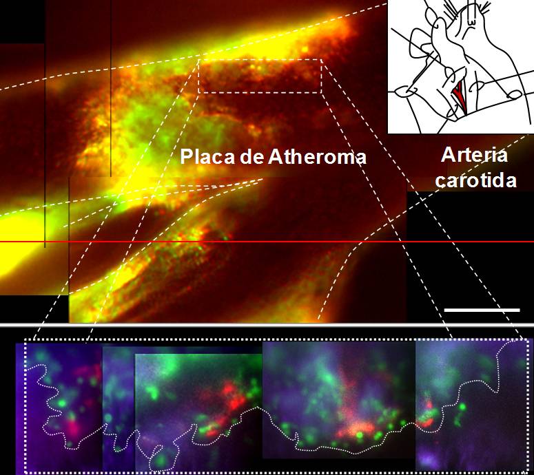 placa de ateroma