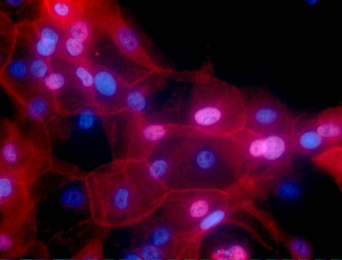 Detectan ocho tipos de cáncer en sangre antes de que se extiendan