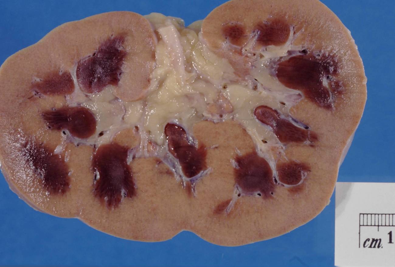 El crecimiento en la enfermedad renal crónica