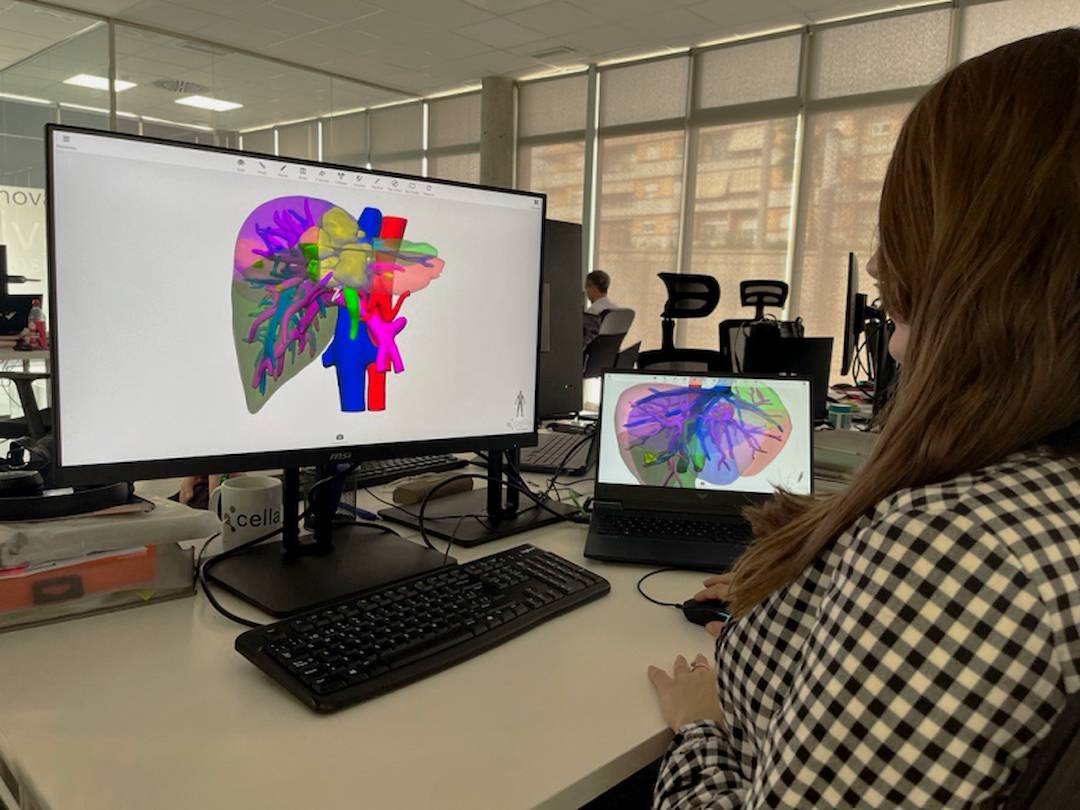 Esta ‘startup’ ayuda a los cirujanos con sus modelos en 3D de órganos de pacientes