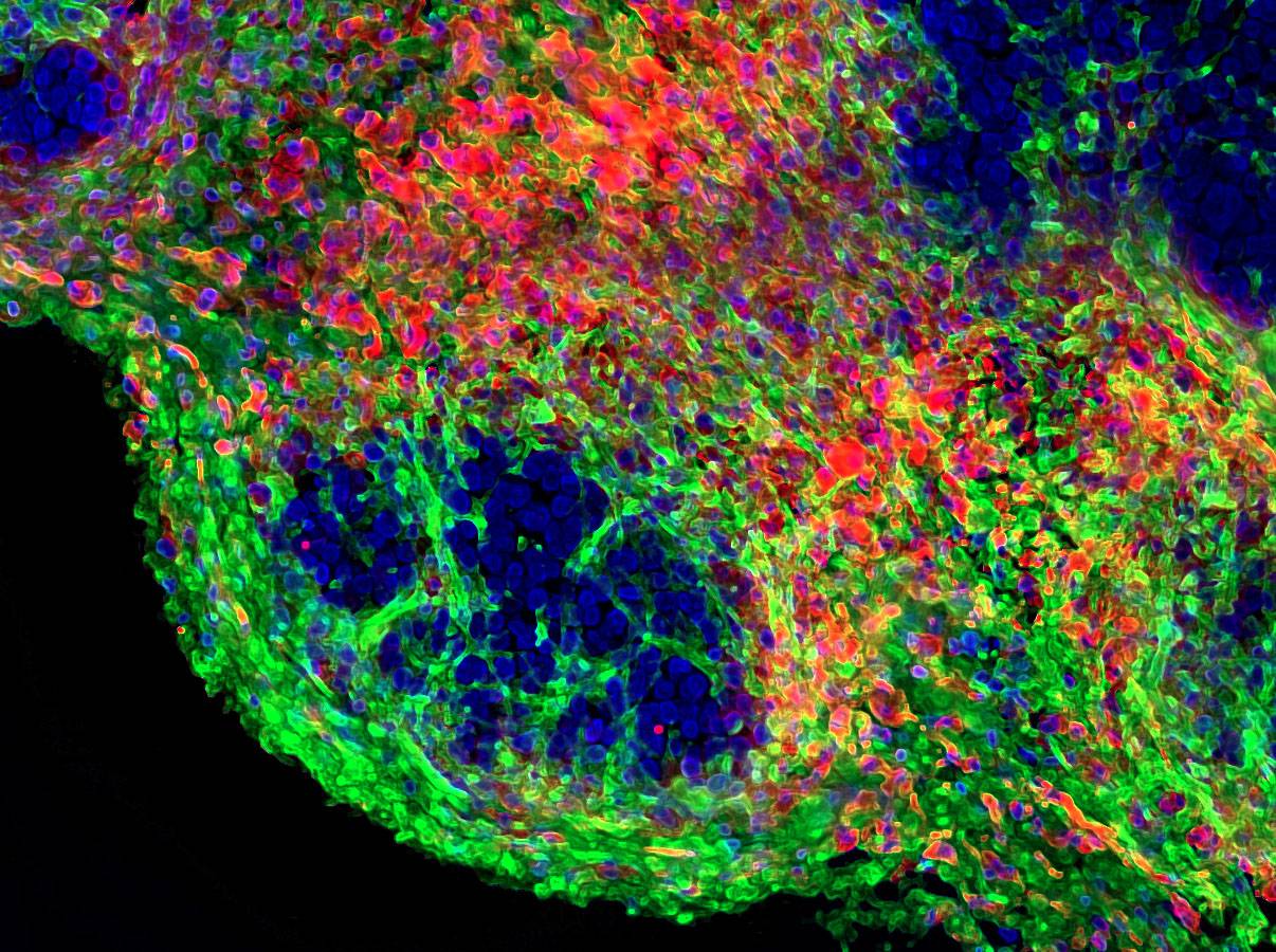 Microentorno, el ecosistema olvidado del cáncer