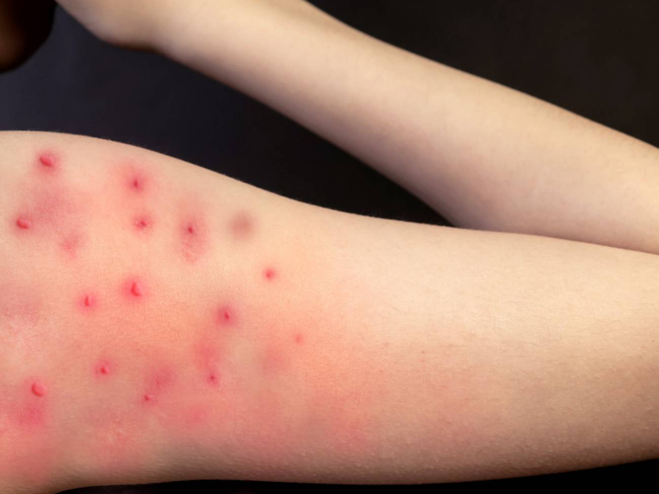 Monkeypox: cómo hablar de enfermedades infecciosas sin estigmatizar a ningún colectivo